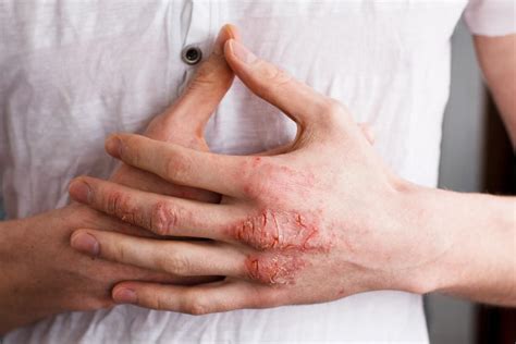 Dont Scratch What To Do When Your Eczema Itches