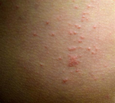 Rashes That Look Like Scabies Causes Symptoms And Tre Vrogue Co