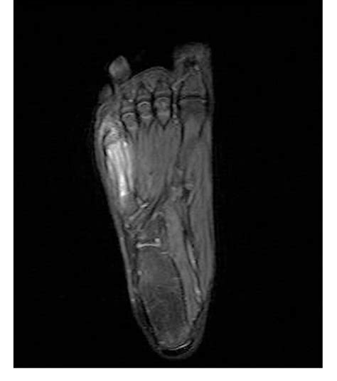 Figure 3 From Low Grade Osteomyelitis Of The Fifth Metatarsal With Possible Concomitant Freiberg