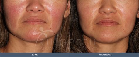 Rosacea Treatment And Medication Philadelphia Rosacea Laser Therapy Pa