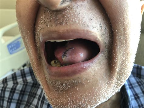 Tongue Cancer Treated By Surgery Dr Jeeve Ent Specialist