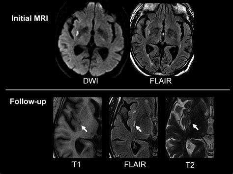 Do Transient Ischemic Attacks With Diffusion Weighted Imaging