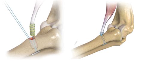 Biceps Tendon Tear Raleigh Hand Surgery — Joseph J Schreiber Md