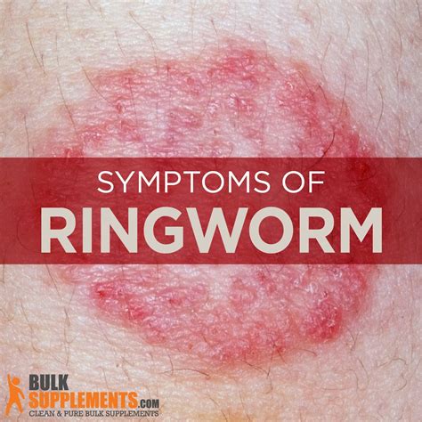 Ringworm Symptoms Causes And Treatment James Denlinger Medium