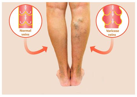 Varicose Veins Los Angeles Ca And Encino Ca La Vascular Specialists