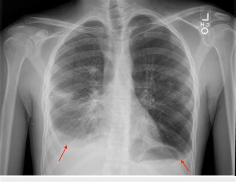 Chest X Ray With Pleural Effusion