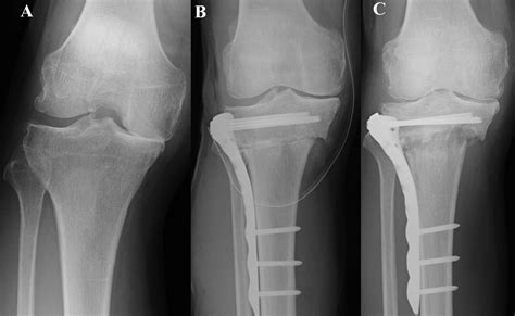 Re Correction Osteotomy With Osteophyte Graft For Correction Loss With