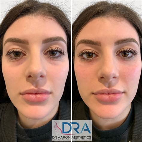 Dermal Fillers Archives Dr Aaron Stanes Anti Ageing And Cosmetic