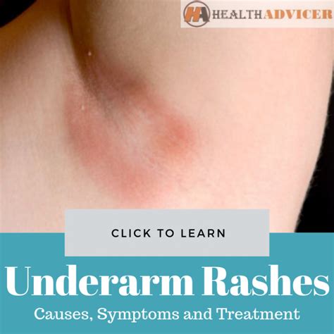 Underarm Rashes Causes Picture Symptoms And Treatments