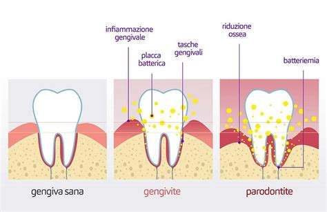 Parodontologia Prevenzione E Cura Della Parodontite E Patologie Gengivali