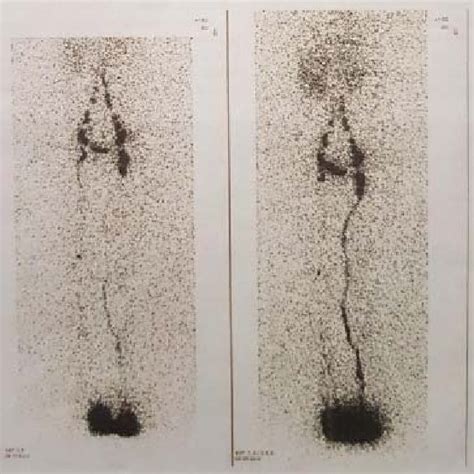 Preoperative Lymphoscintigraphy In A Patient Affected By Left Leg