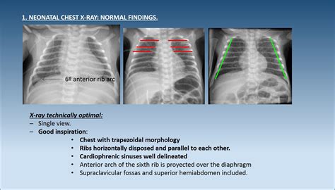 Normal Infant Chest Xray