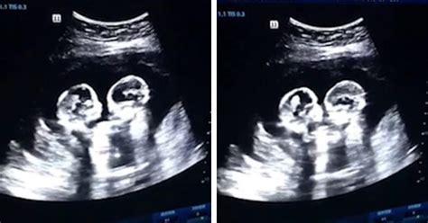 Check spelling or type a new query. 100+ EPIC Best 11 Week Ultrasound Identical Twins - hd ...