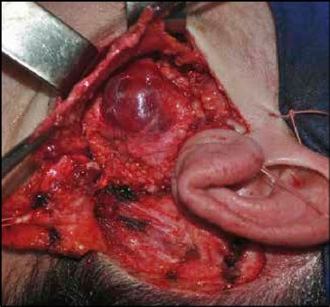 Intraoperative View Of The Benign Parotid Gland Tumor Situated In The