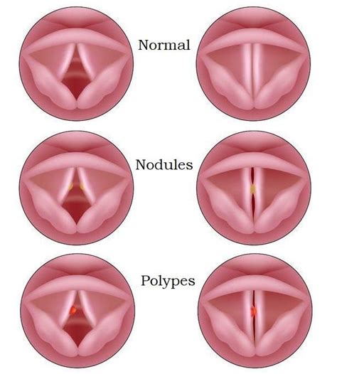 Cette intervention est indiquée pour des lésions bénignes des cordes vocales (nodules, polypes, kystes, œdèmes). Les nodules et les polypes aux cordes vocales ...