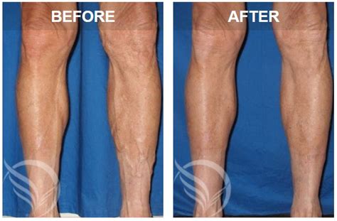 Visible Veins When Should I Worry Vein Specialists Of The South
