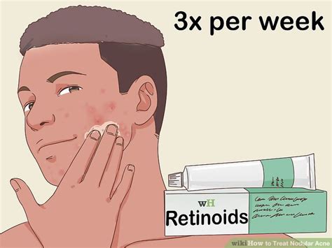 How To Treat Nodular Acne 13 Steps With Pictures Wikihow