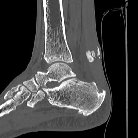 A compromised achilles tendon can cause discomfort from a slight ache, tenderness, and stiffness to severe pain, especially when bending the. Post traumatic achilles tendon ossification | Image ...