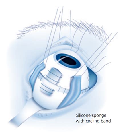 Implants For Retinal Detachment Geuder