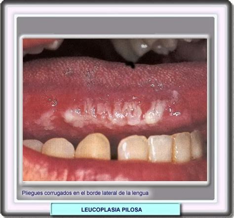 Patología Leucoplasia Oral