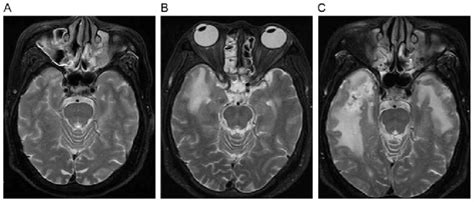 Evolution Of A White Matter Lesion A Axial T2‑weighted Image Reveals