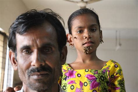 Bangladeshi Girl May Be First With Female Tree Man Syndrome Newshub