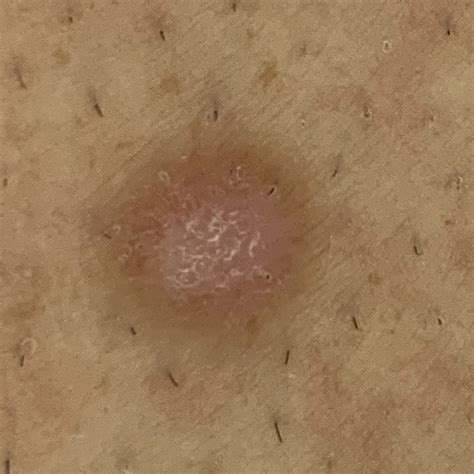 Dermatofibroma Spot Check Skin Cancer Aesthetics Melbourne Cbd