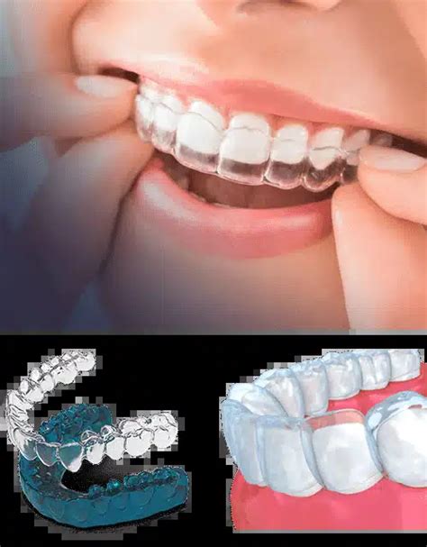 Invisalign Clear Braces In Mississauga Ontario