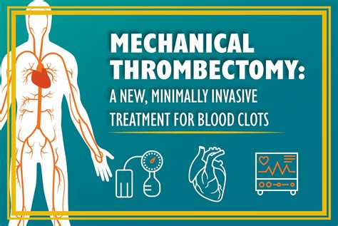 Mechanical Thrombectomy A Minimally Invasive Treatment For Blood Clots
