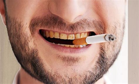 What Is The Black Stuff On Teeth That Smokers Get Directorio
