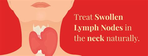 How To Treat Swollen Lymph Nodes In Neck Naturally