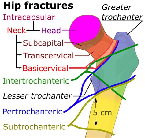 Fractured Neck Of Femur Fnof Orthopaedics Geeky Medics