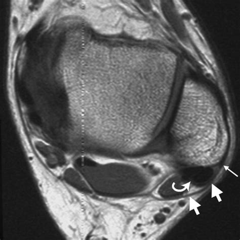 Mri Musculo Skeletal Section Peroneal Tendon Lesions