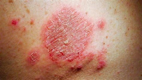 Common Skin Rashes