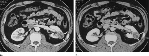 5.2.2 ct or mri ct or mri are used to characterise renal masses. Renal cell carcinoma confined to the kidney (TNM stages T1 ...