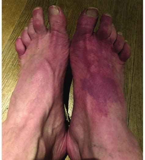 Patchy Purple Discoloration Of The Right Foot During An Episode Of