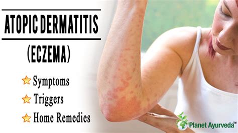 What Is A Home Remedy For Atopic Dermatitis In Dogs