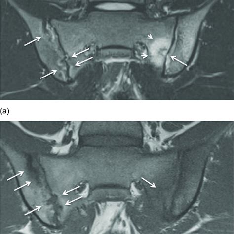 Pdf Common Incidental Findings On Sacroiliac Joint Mri In Children