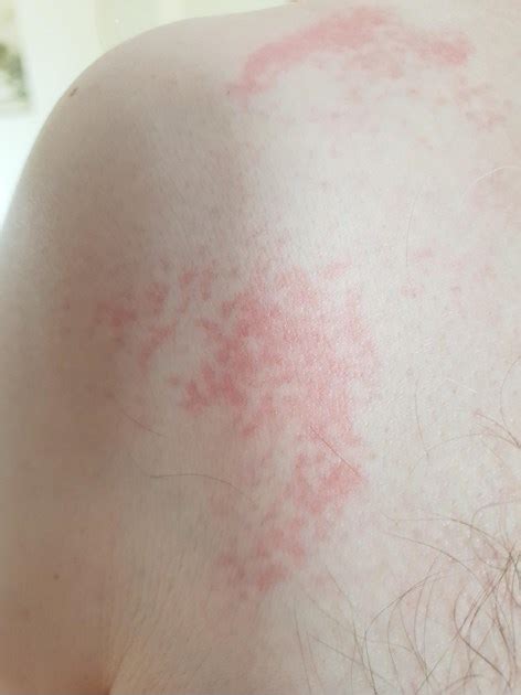 Any Ideas On These Rashes Lupus Hi Been Getting Lupus Uk