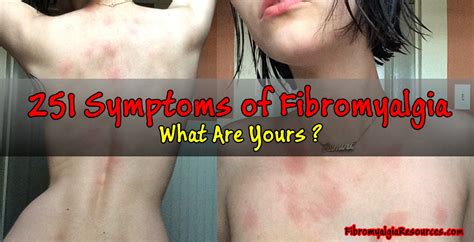 251 Symptoms Of Fibromyalgia Hard To Believe What Are Yours