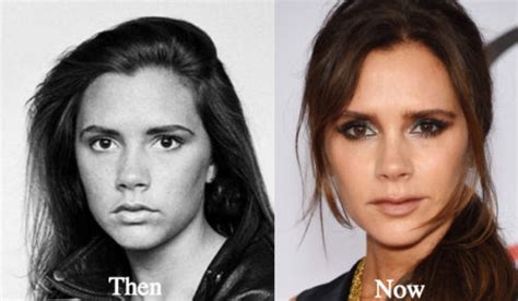 Victoria Beckham Plastic Surgery Before And After Photos
