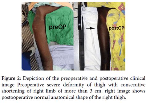 Orthopedic Muscular System Preoperative Clinical Deformity