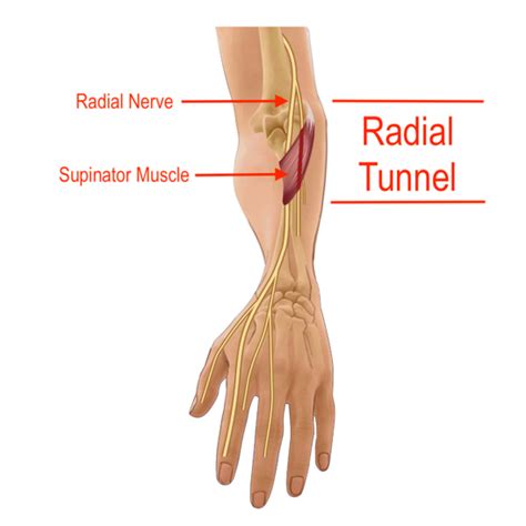 Radial Tunnel Syndrome ChiroUp