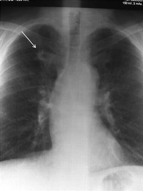 Picture Lung Cancer Pulmonary Nodulosis And Aseptic Granulomatous