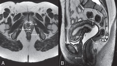 Detailed image and reproductivethis medical illustration depicts a detailed. Normal female pelvis. Axial (A) and sagittal (B) MRI T2-weighted images... | Download Scientific ...