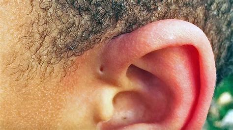 Have You Ever Spotted This Small Hole Above Someones Ear This Is The