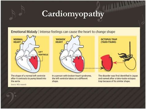 Takotsubo Cardiomyopathy Or So Called Heart Break Syndrome