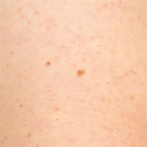 Keratosis Pilaris Everything You Need To Know About “chicken Skin