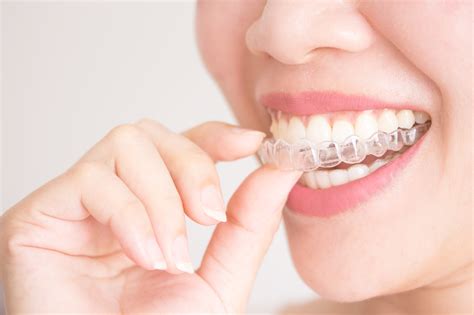 Clear Teeth Aligners 3 Tips For Success Healthymenstore