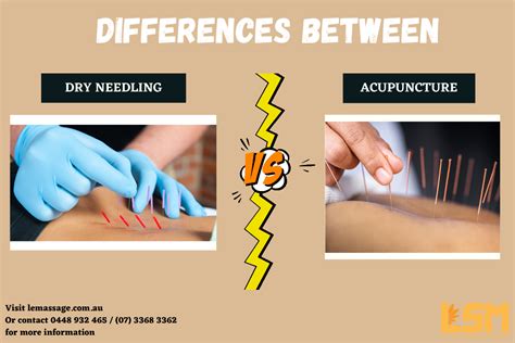 5 differences between acupuncture and dry needling le spa massage academy